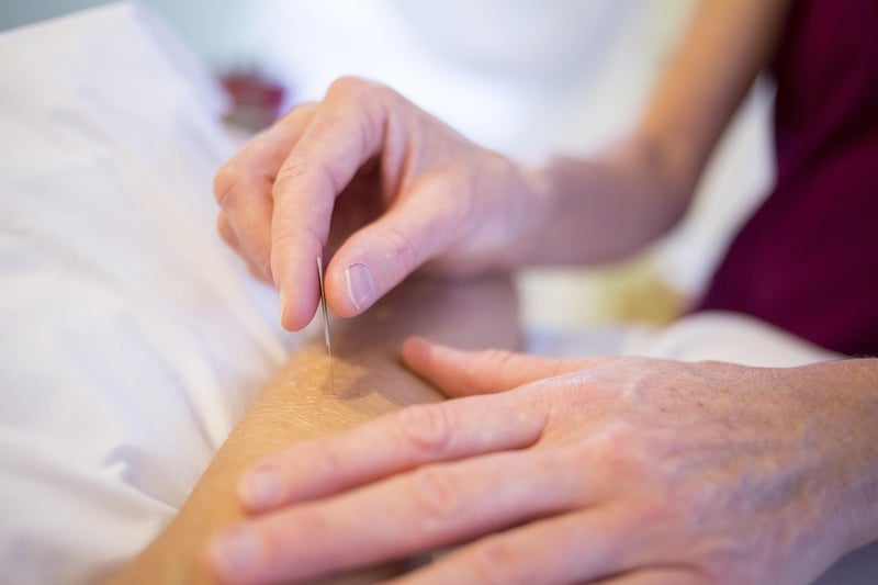 Acupuncture Treatment